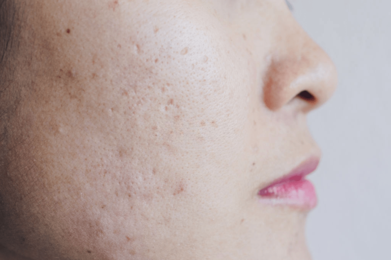 Tips To Get Rid Of Acne Scars Hiruscar Malaysia