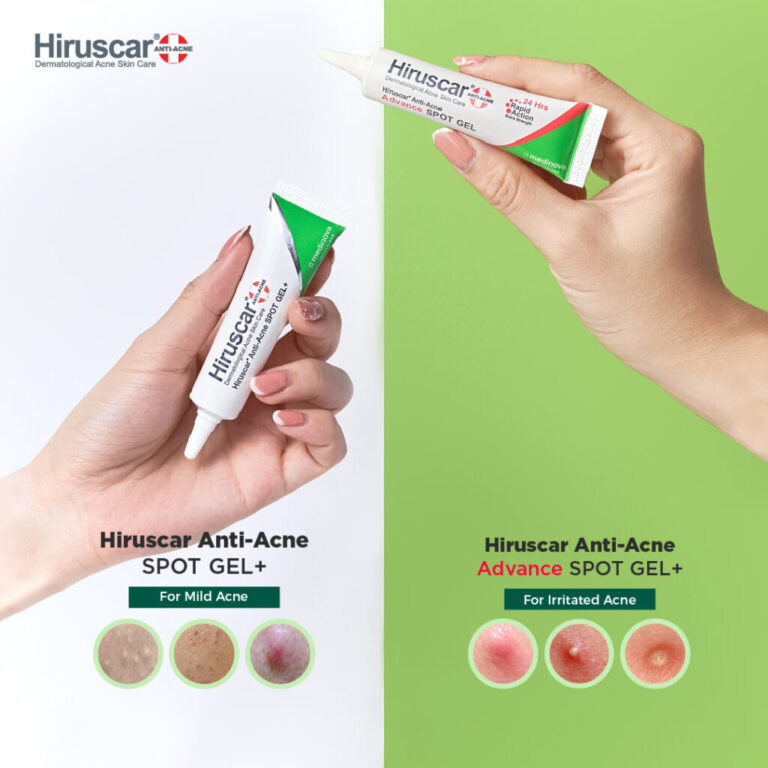 Jenis-Jenis Jerawat dan Cara Mengatasinya Dengan Hiruscar Anti-Acne