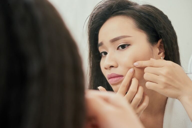 Removing Adult Acne Scars