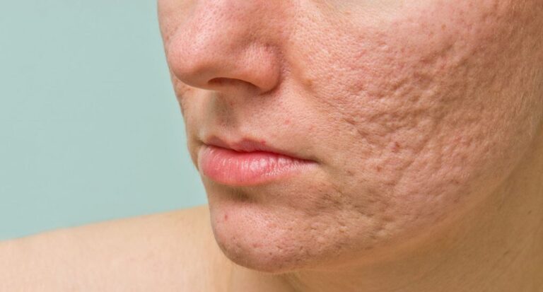 Acne: Causes and How to Prevent Them