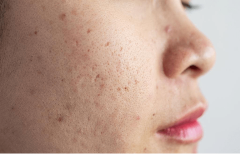 5 Non-Invasive Ways To Get Rid Of Acne Scarring