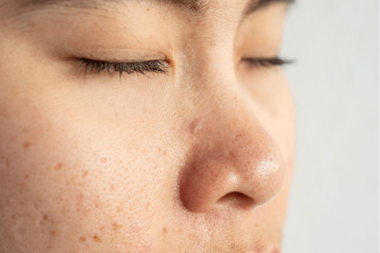 Quick and Easy Skincare Routine for Acne-prone Skin