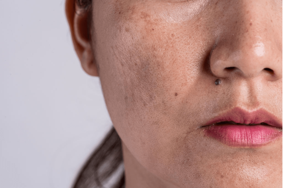 how-to-remove-dark-acne-scars-hiruscar-malaysia