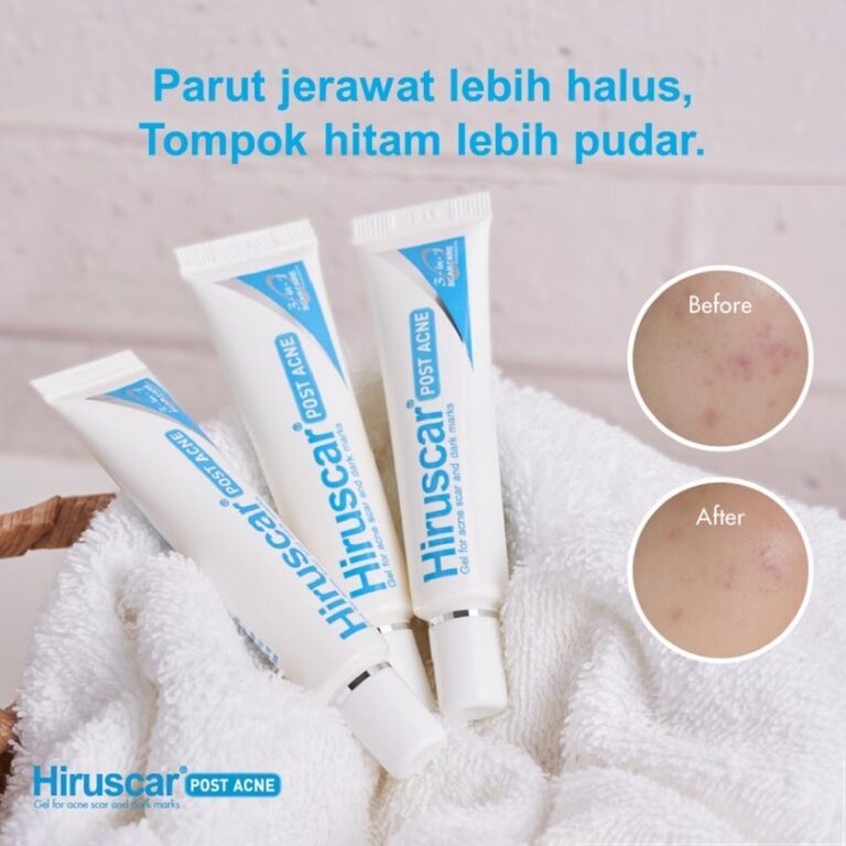 Muka naik jerawat akibat ‘maskne’, Hiruscar Post Acne adalah jawapannya!