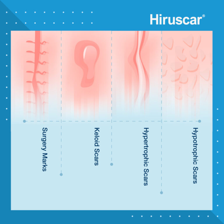 Love Your Scars Away: Scar Care with Hiruscar